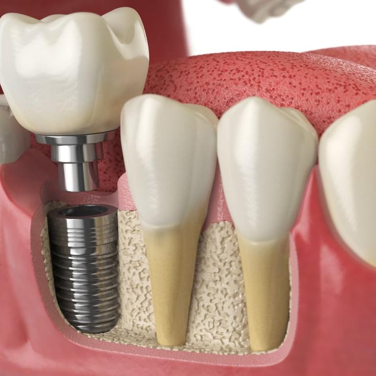 Tratamiento de implante dental