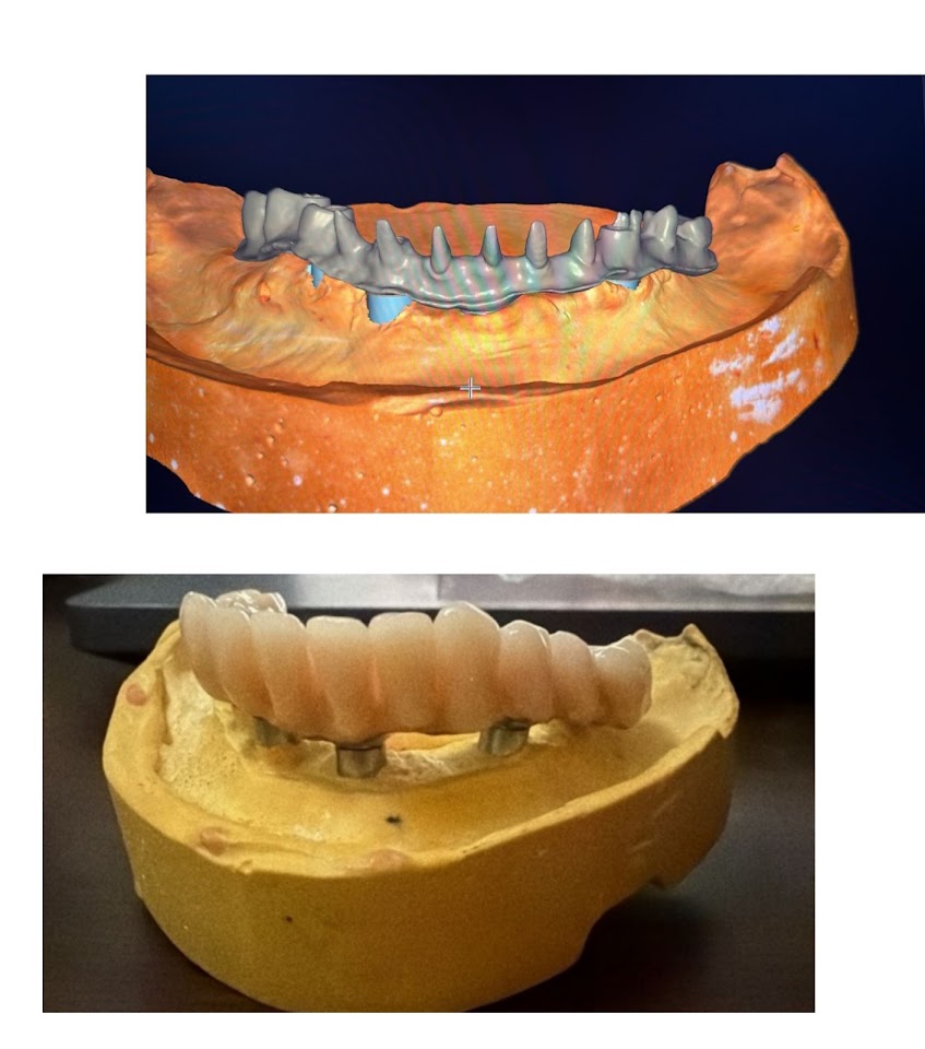 Prótesis dental a medida
